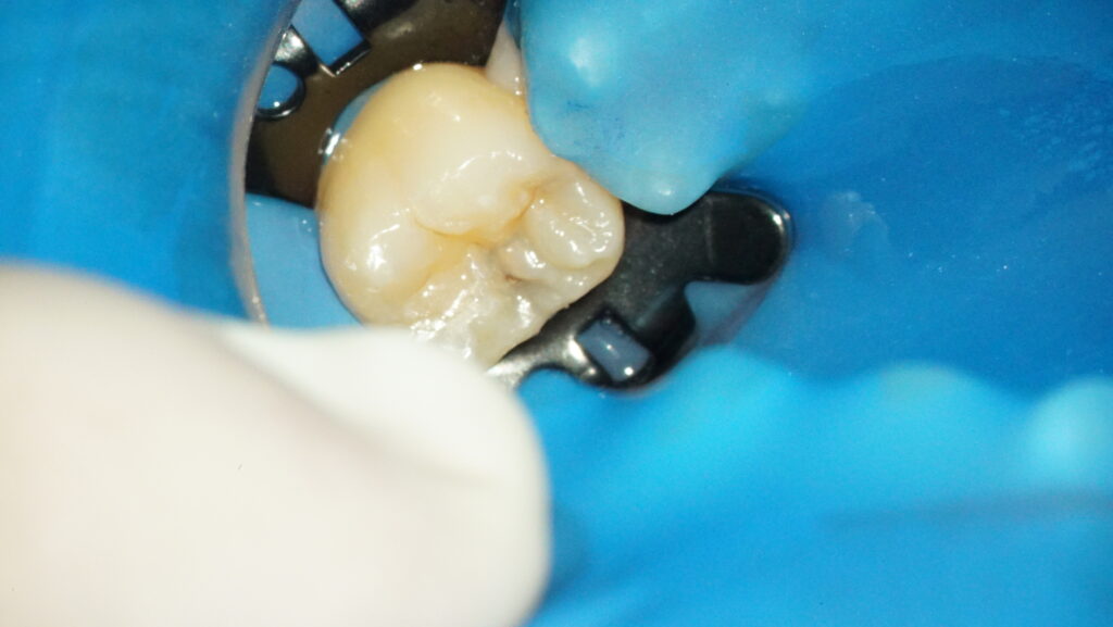 歯科衛生士がメインテナンス中に顕微鏡で虫歯を発見